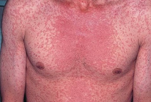 Se crea la vacuna contra la rubéola