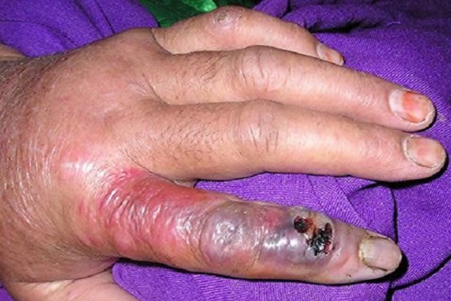 The first case of Anthrax has since 1976