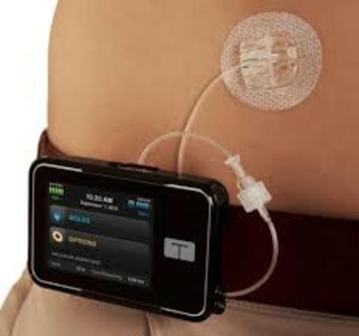 Modern insulin pump