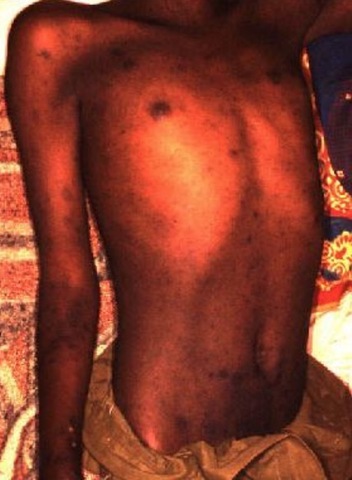 Se crea la vacuna contra el tifus