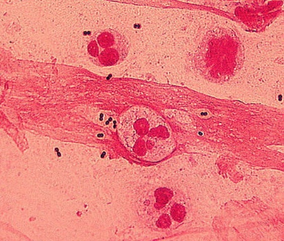 Se crea la vacuna contra la neumonía