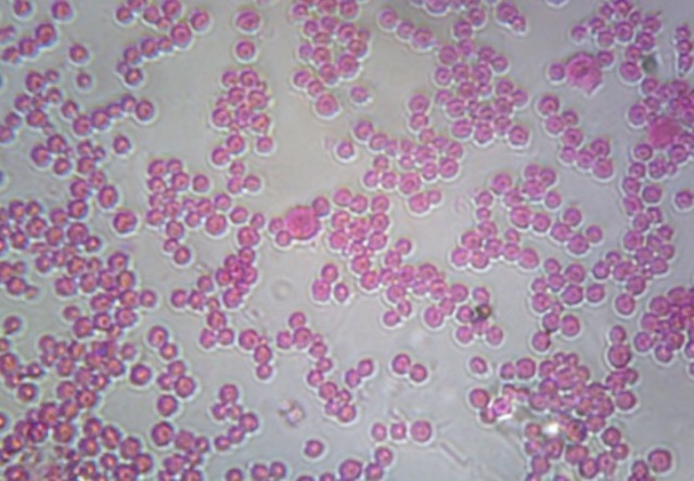 Se crea la vacuna para la meningitis