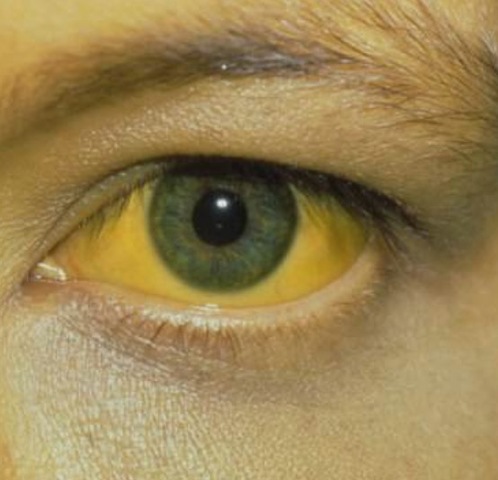 Se crea la vacuna para la hepatitis A