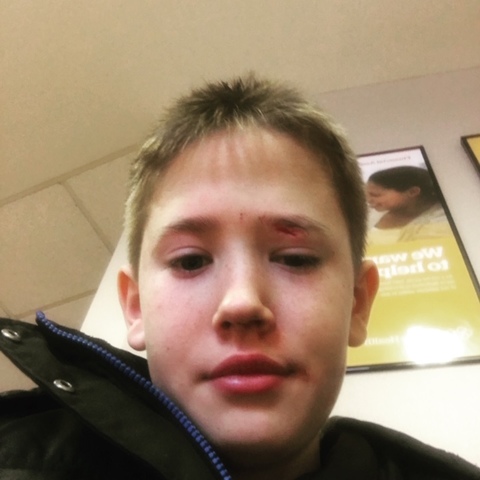 I get my eyebrow sliced