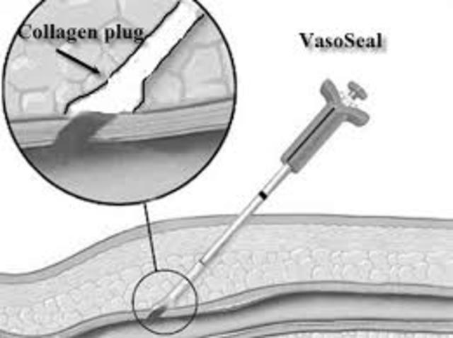 Vasoseal