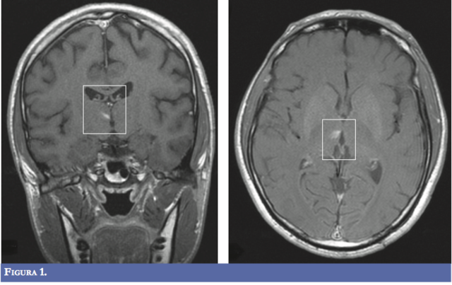 Resonancia magnética encefálica.