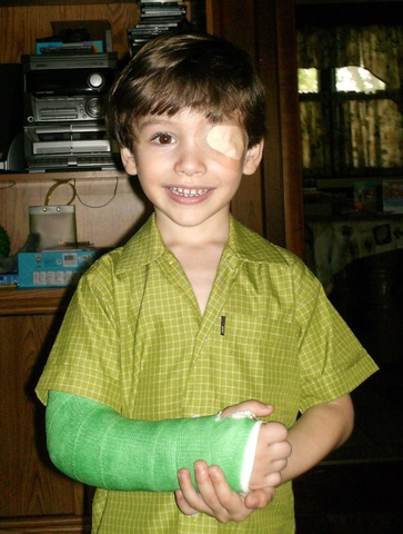 Broken Arm