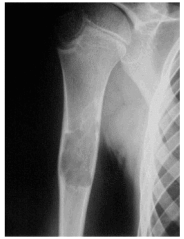 Me operan en el brazo por un quiste oseo