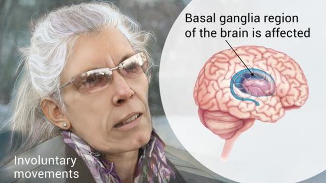 Enfermedad de Huntington