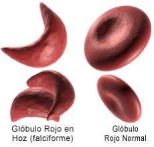 Vernon Ingram proclamó el descubrimiento de que un solo cambio en la cadena protéica de la hemoglobina era uno de los factores responsables de la anemia de células falsiformes.