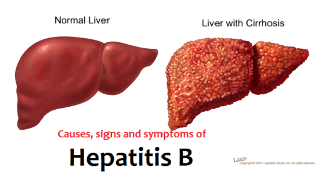 Vacuna de Hepatitis B