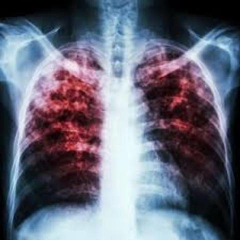 SUSCEPTIBILIDAD A LA TUBERCULOSIS