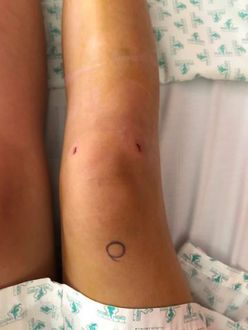 Me operan de la rodilla