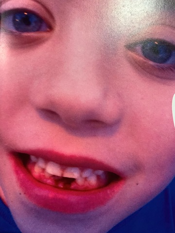 First Tooth Falls out