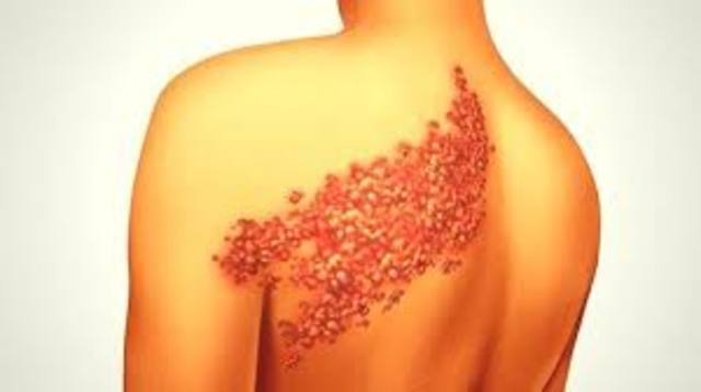 Publicación artículo referente a la culebrilla.