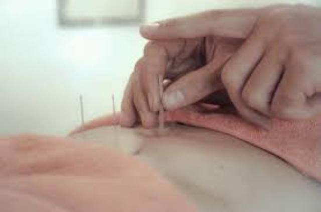 Acupuntura