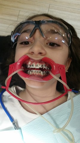 I get Braces