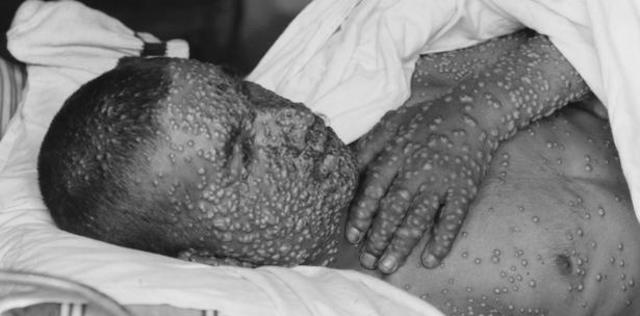 Se erradica la viruela en México