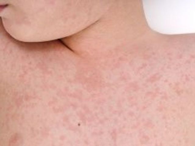 Sarampión se elimina de México