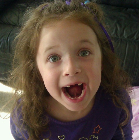 losing a lot of teeth