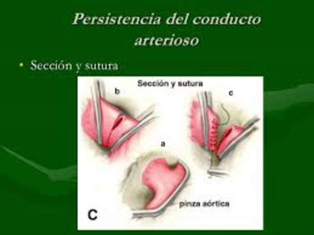 Ligadura y sutura del conducto arterioso