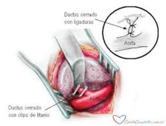 Conducto Arterioso