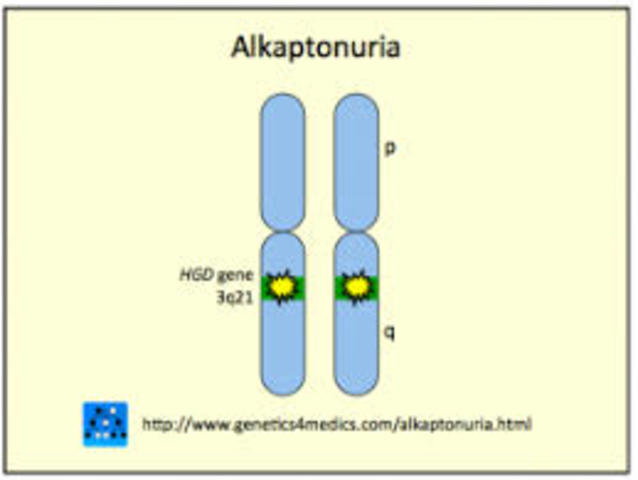 Alkaptonuria