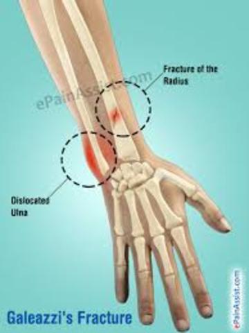 Isabella's Broken Bone