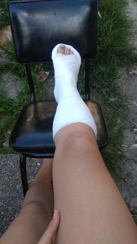 Mi pie fracturado