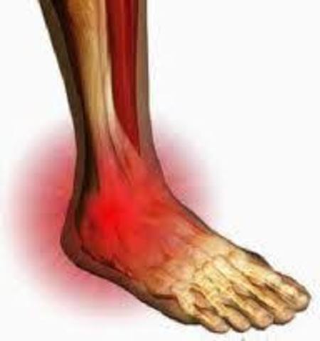 Mi primera fractura :(