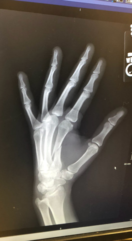 Injury During Brazilian Jiu Jitsu Training