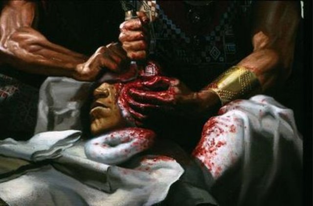 Trepanación Craneana