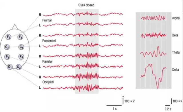 Electroencefalograma (EEG)