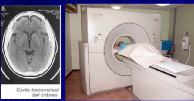 Tomografia axial Computarizada (TAC)