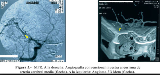 Angiografia