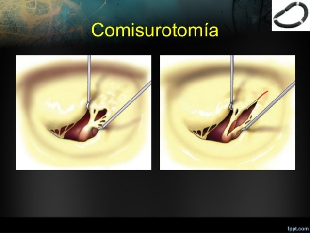 COMISUROTOMIA MITRAL