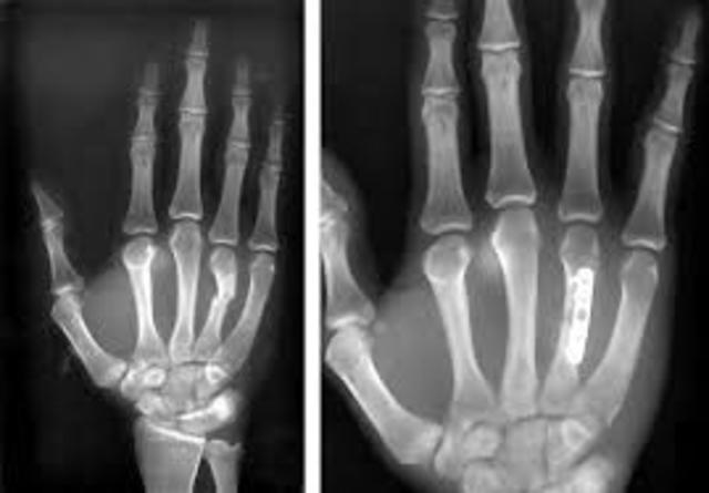 I fractured 3 bones in my hand