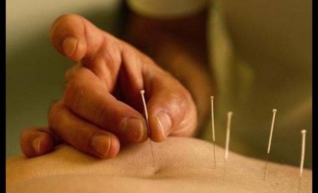 Acupuntura (Medicina tradicional china)