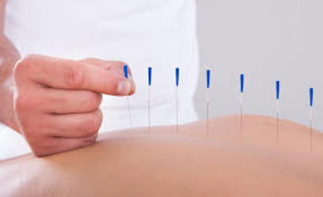 Tradicional China (Acupuntura)