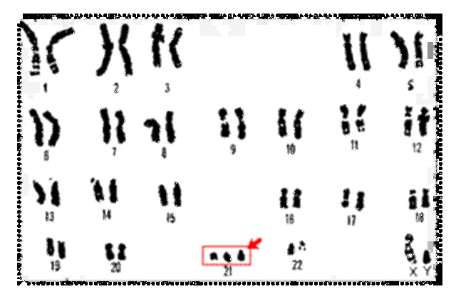 Genetic disorder caused by copying one more chromosome: Down syndrome