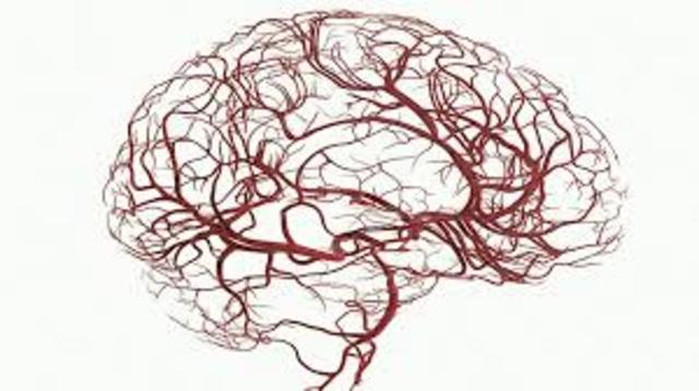 Características: Isquemia Global