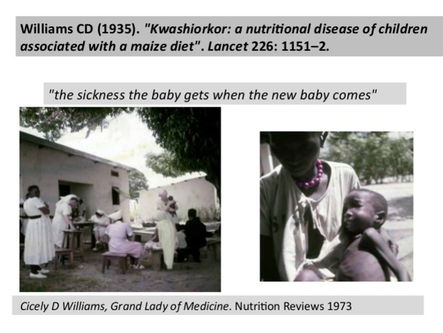 Descripción de kwashiorkor en un artículo en la revista Lancer por Cicely Williams