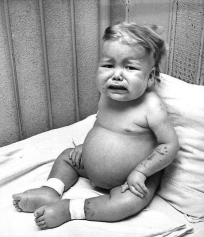 Se conocía el Kwashiorkor en Europa