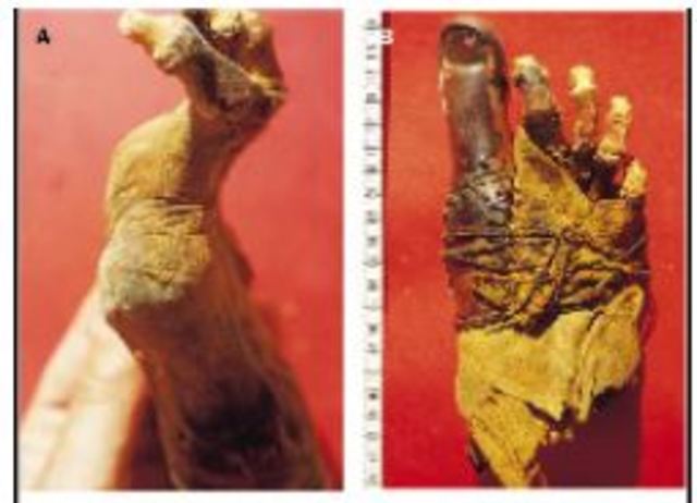 Prótesis del dedo gordo del pie