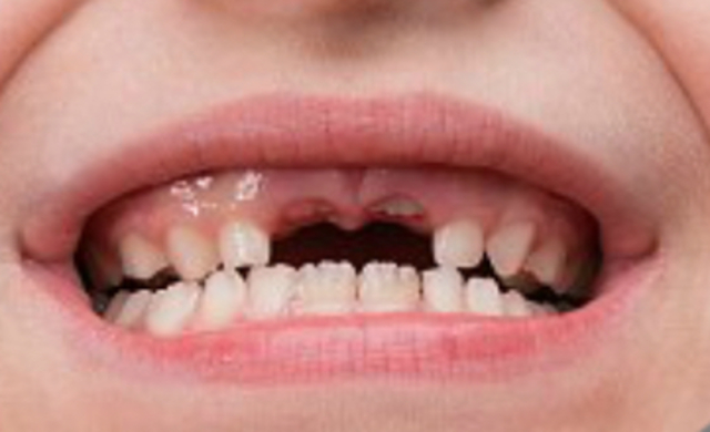 He visited a dentist to get his front teeth broken.