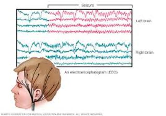 Seizure