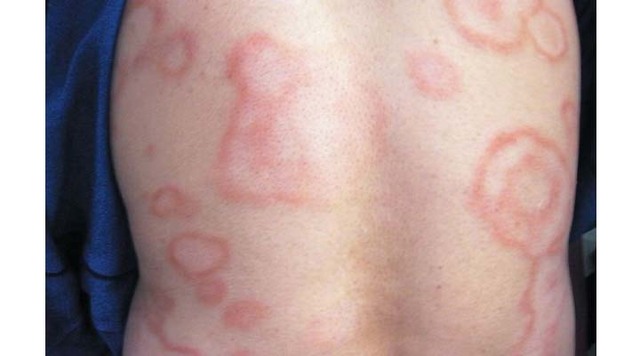 La Asamblea Mundial de la Salud adopta una resolución para eliminar la lepra.