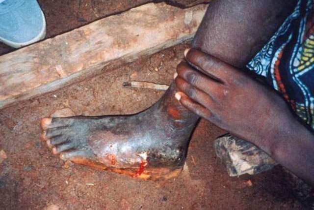 Establecimiento de la Comisión Internacional para la Certificación de la Erradicación de la Dracunculosis