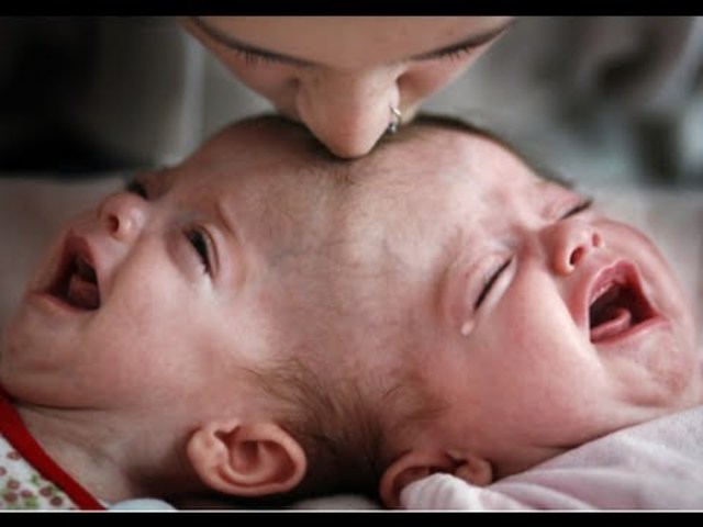 SEPARATE CRANIOPAGUS TWINS