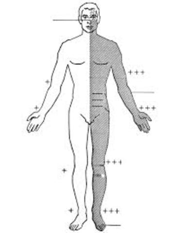 Ataque cerebro-vascular